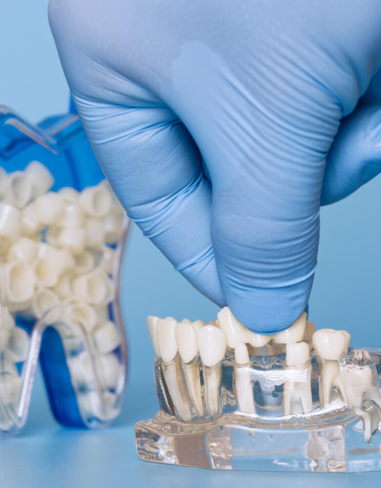 Digitalna izrada preciznih cirkonskih krunica u dentalnom laboratoriju